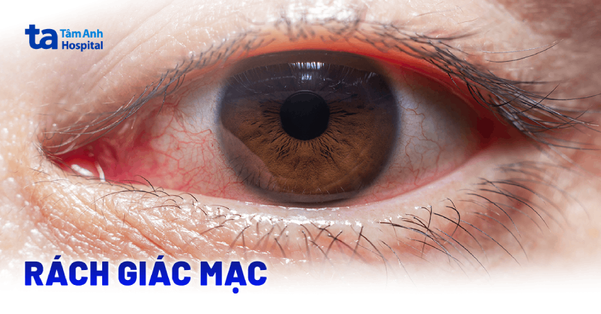 Rách giác mạc có nguy hiểm không? Nguyên nhân, dấu hiệu và điều trị