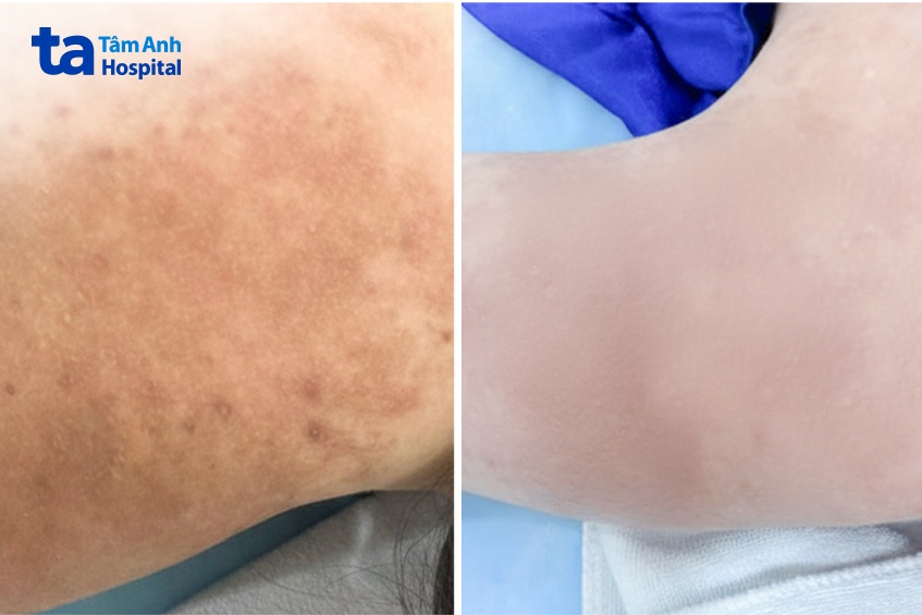 sau khi điều trị tại bệnh viện tâm anh