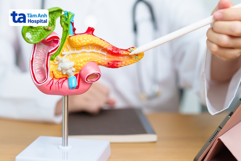 tắc mật ngoài gan gây viêm tụy cấp