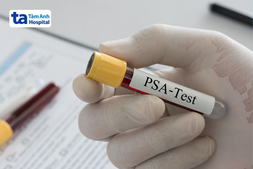 tầm soát sớm giúp phát hiện ung thư tuyến tiền liệt