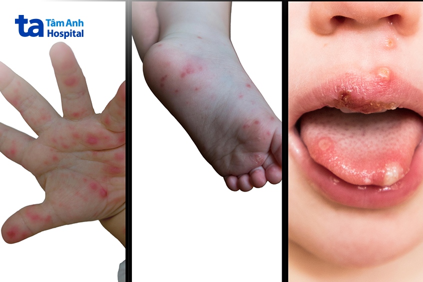 Tay chân miệng là bệnh do virus đường ruột gây ra, biểu hiện bằng các nốt đỏ hoặc mụn nước trên tay, chân và miệng