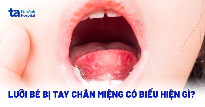 Tay chân miệng ở lưỡi: Những điều cha mẹ cần biết