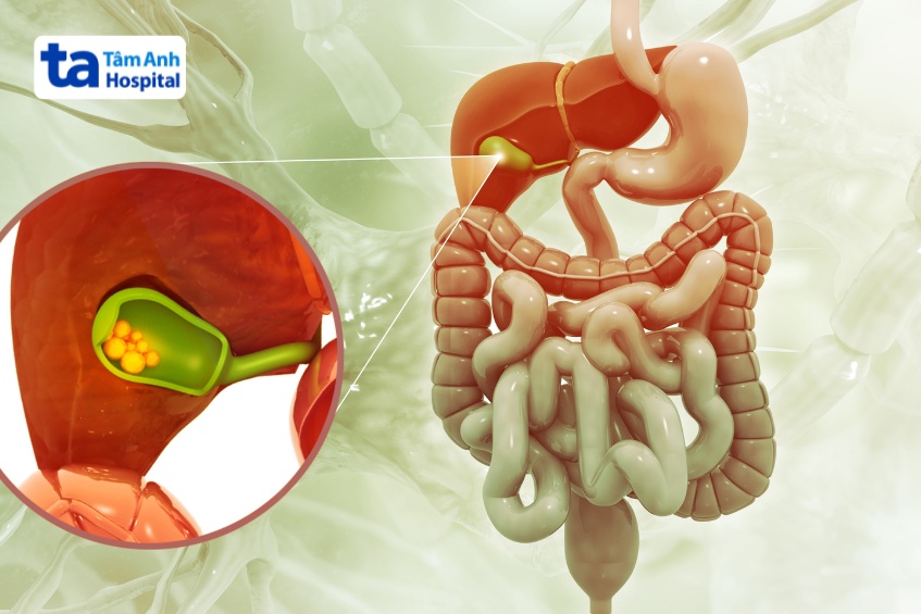 teo đường mật gây tắc mật