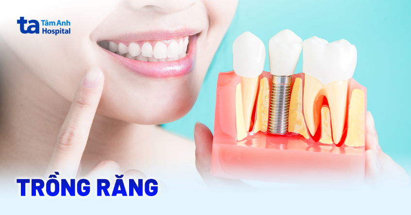 Các phương pháp trồng răng phổ biến và ưu nhược điểm