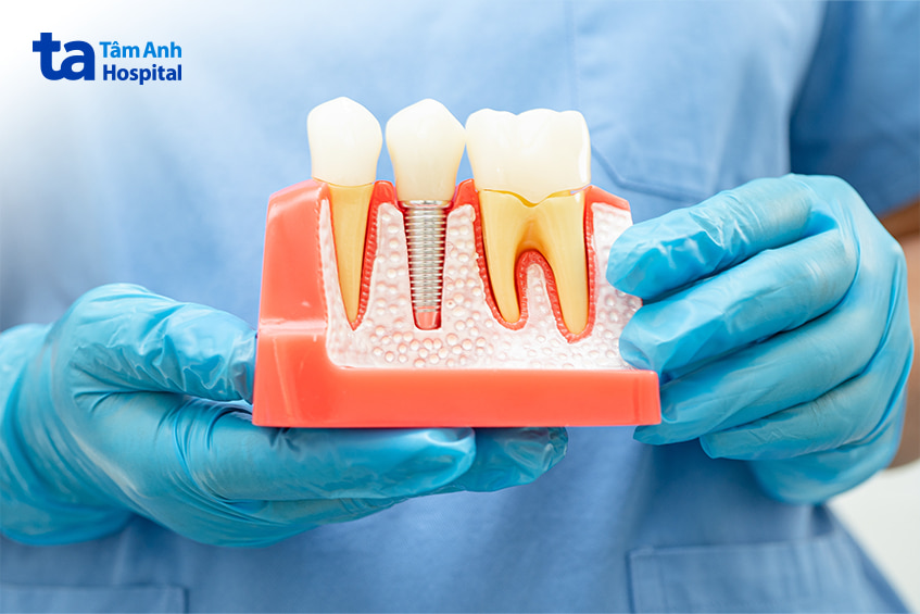 Mô phỏng trụ titanium trong kỹ thuật trồng răng implant thay thế răng đã mất