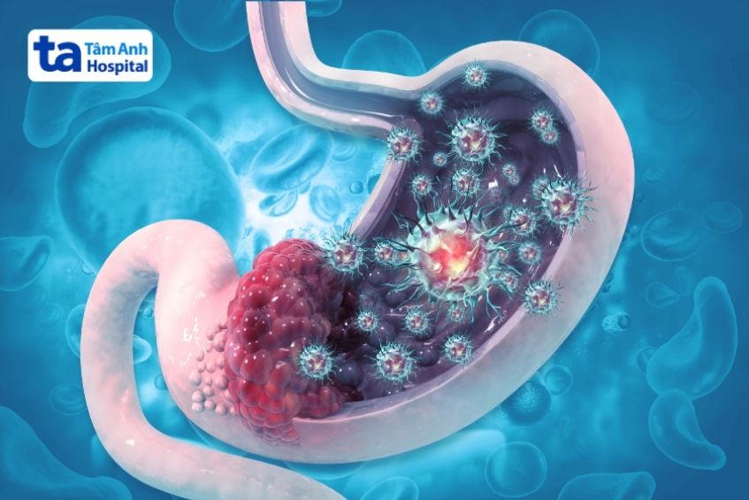 ung thư dạ dày giai đoạn đầu dễ bị nhầm lẫn