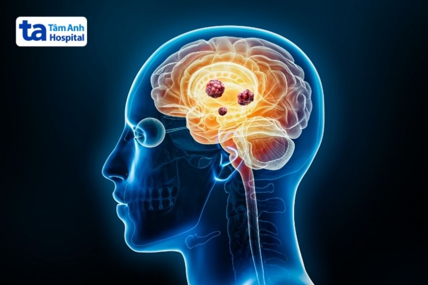 ung thư não khó chữa