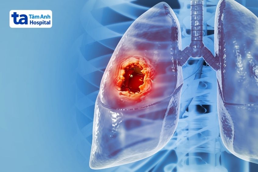 ung thư phổi khó chữa