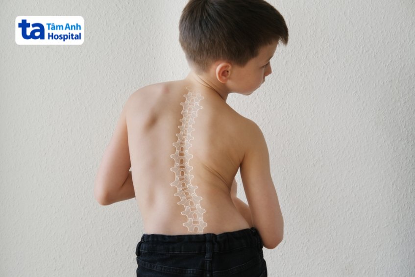 vẹo cột sống ở trẻ em