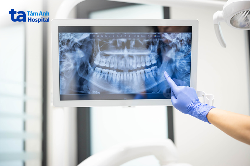 Hình ảnh chụp X-quang răng trước khi trồng răng implant tại nha khoa
