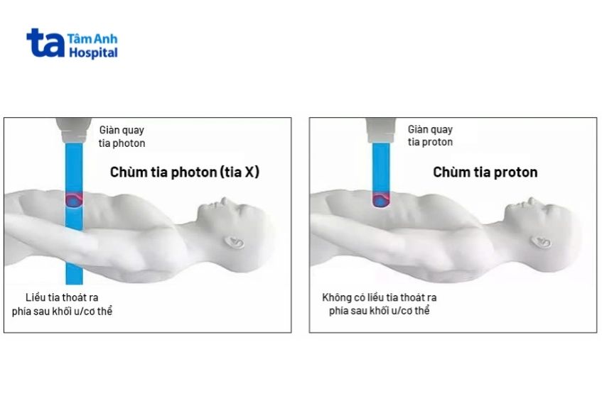 xạ trị photon đưa liều xạ vào khối u