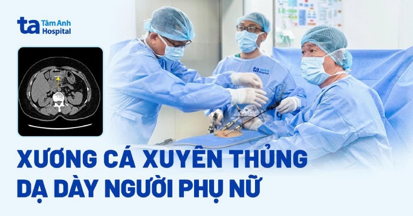 Xương cá xuyên thủng bít dạ dày người phụ nữ