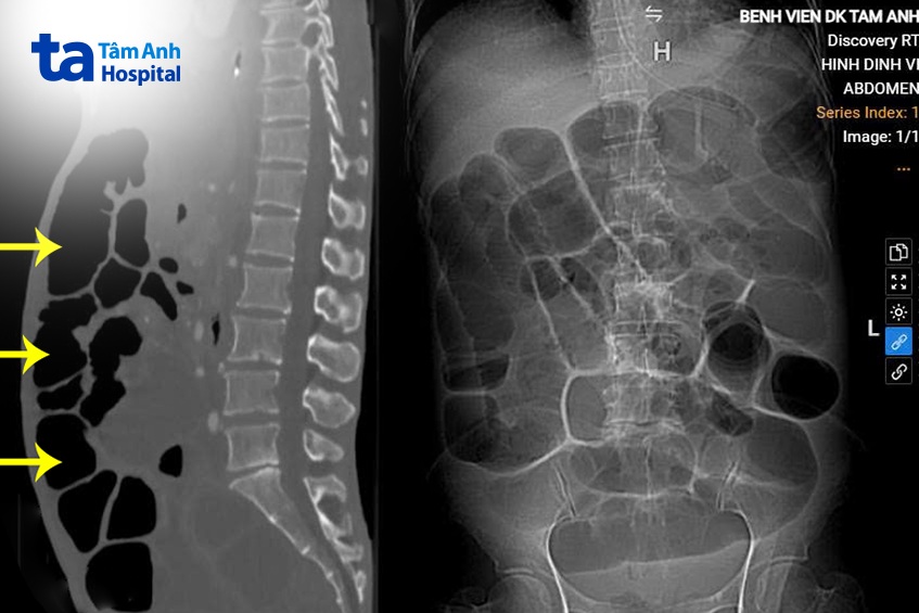 ảnh chụp bụng chướng khí