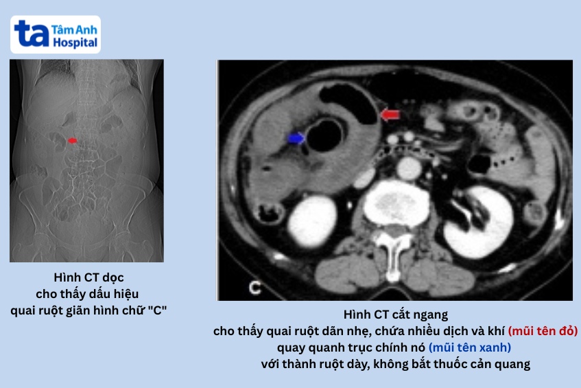 Tắc ruột quai kín là gì? Khác gì so với thông thường? 23 ảnh chụp CT dấu hiệu tắc ruột quai kín