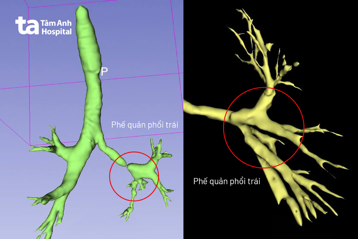Ảnh chụp CT dựng hình 3D trước (trái) và sau mổ (phải) cho thấy phần hẹp phế quản đã được khắc phục gần như hoàn toàn