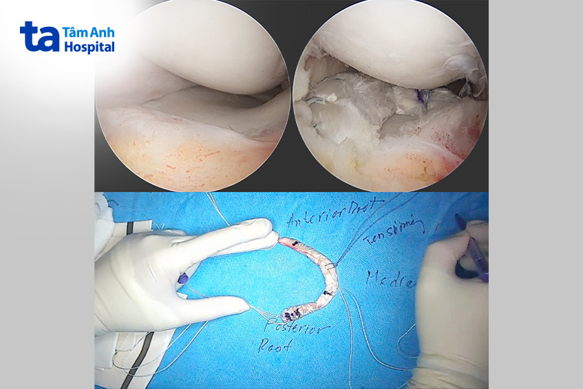 ảnh nội soi khớp gối khuyết sụn chêm (trái) được tái tạo (phải) bằng mảnh ghép tự thân (dưới)