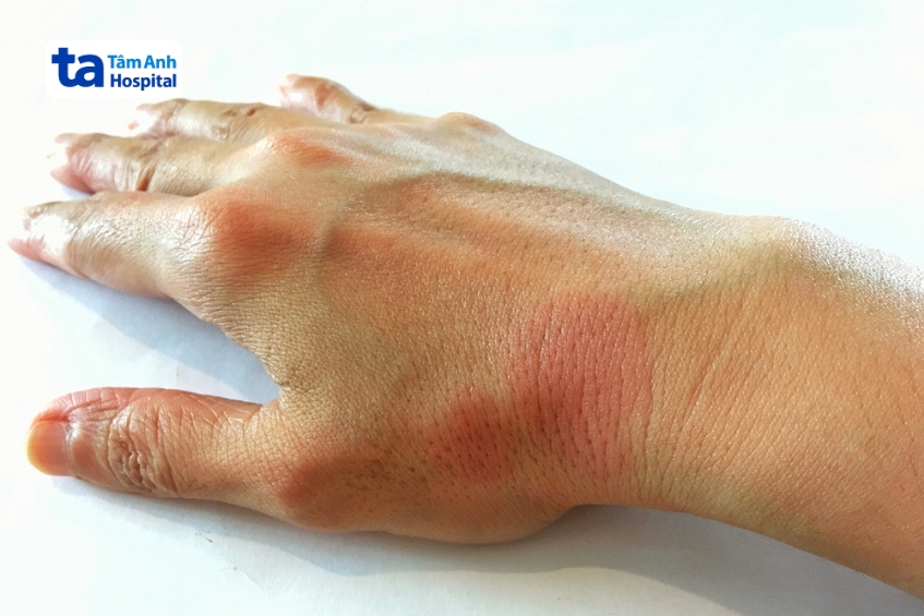 anifrolumab điều trị lupus sle trung bình-nặng