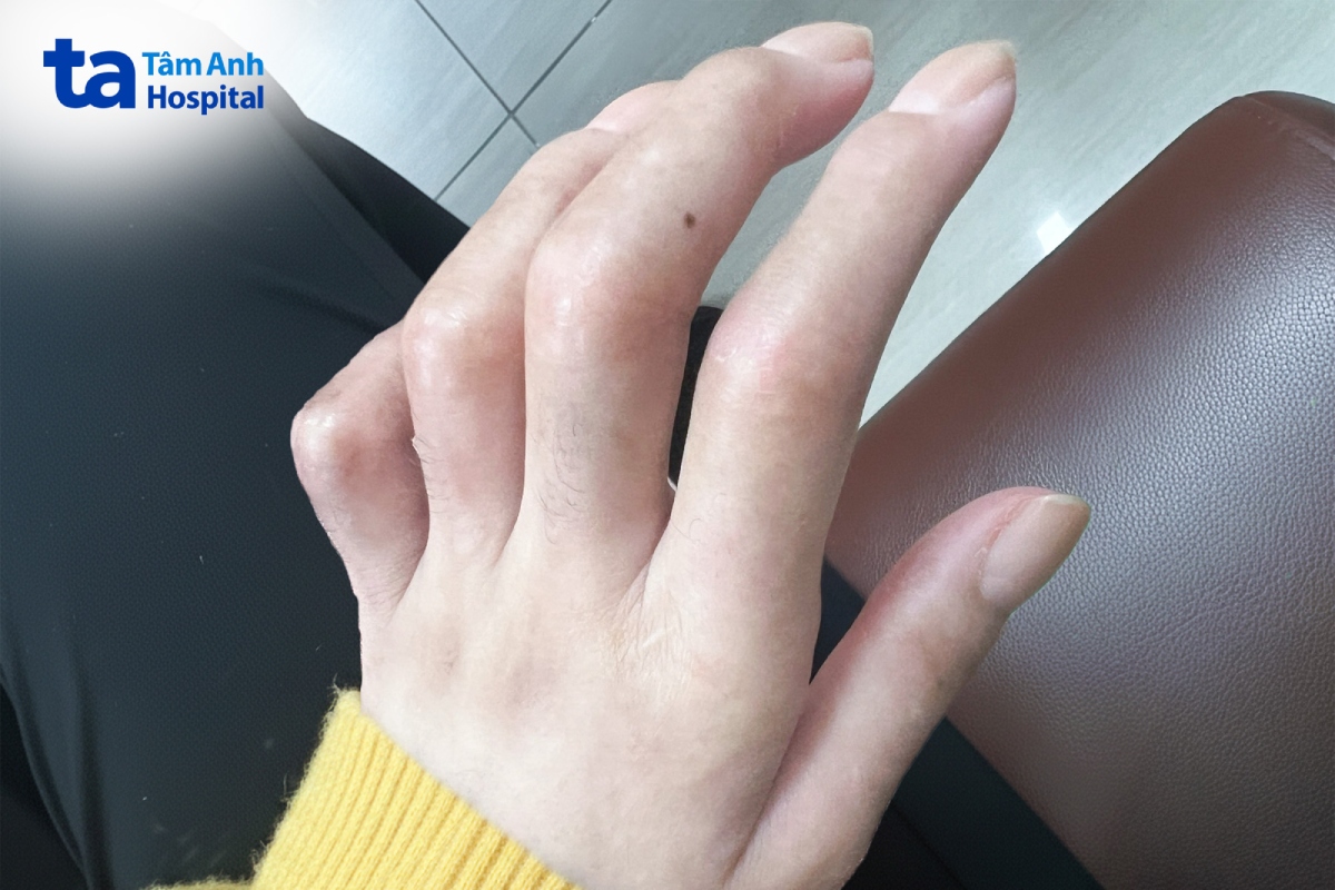 bàn tay chị tú khi mắc chứng xơ cứng bì hiếm gặp