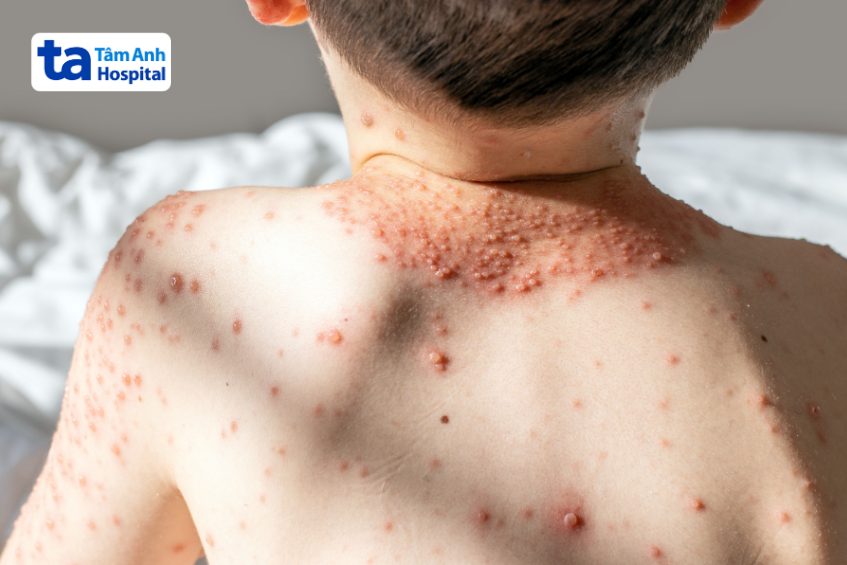 bé bị nổi mụn nước