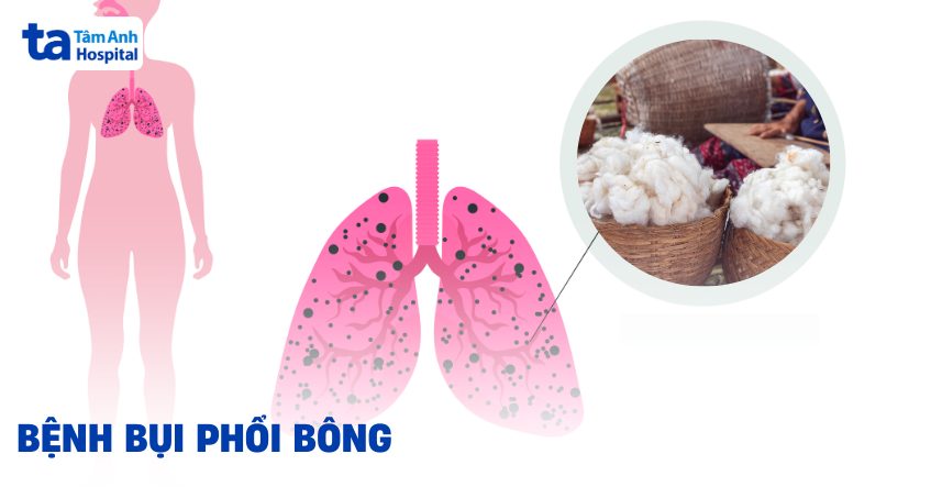 Vấn đề bệnh bụi phổi bông xuất phát từ đâu ra?