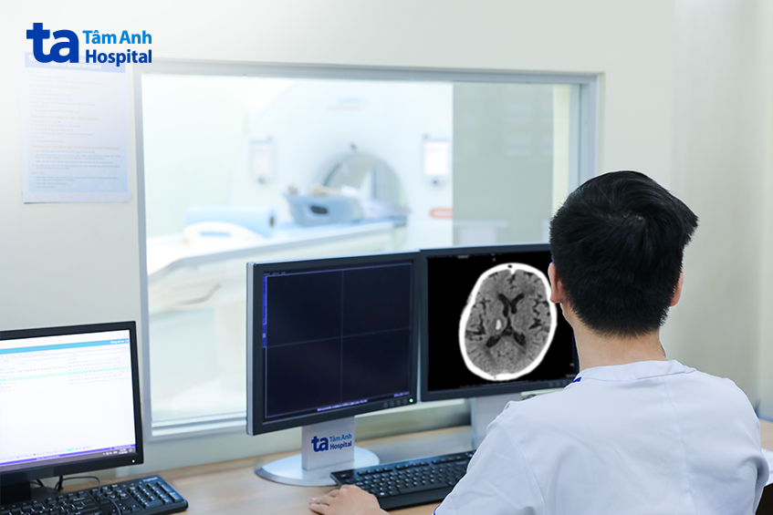 Bệnh nhân được chụp CT não để phát hiện đột quỵ