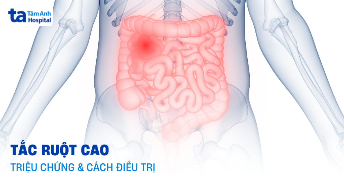 Tắc ruột cao là gì? Nhận biết và xử trí theo hướng nào?