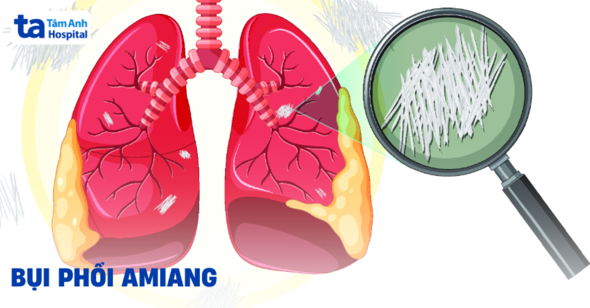 Bệnh bụi phổi Amiang là gì?