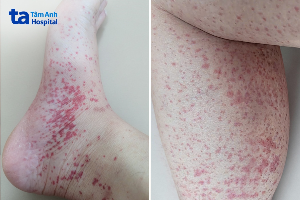 các nốt ban đỏ dày đặc trên chân người bệnh