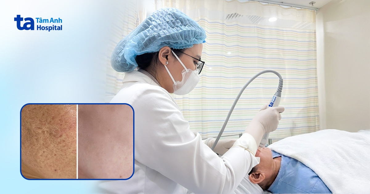 Sẹo rỗ nặng vì tự nặn mụn trong thai kỳ