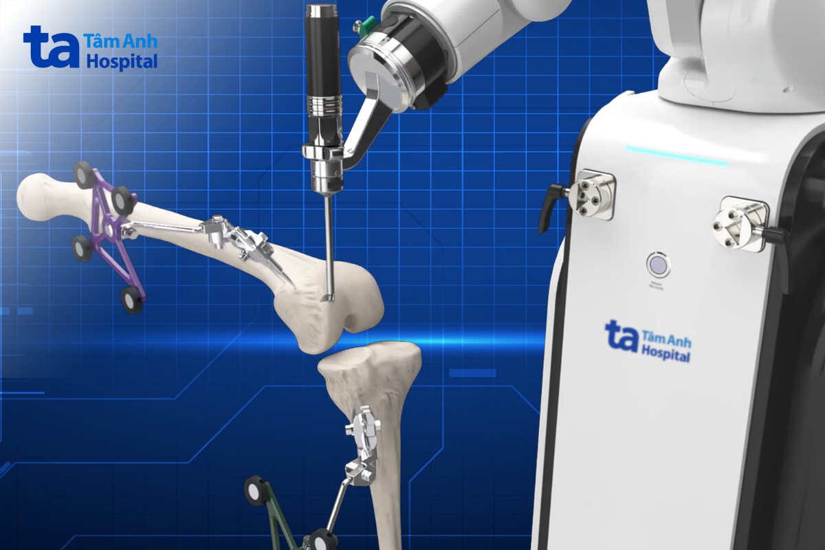 chủ động cắt xương chính xác