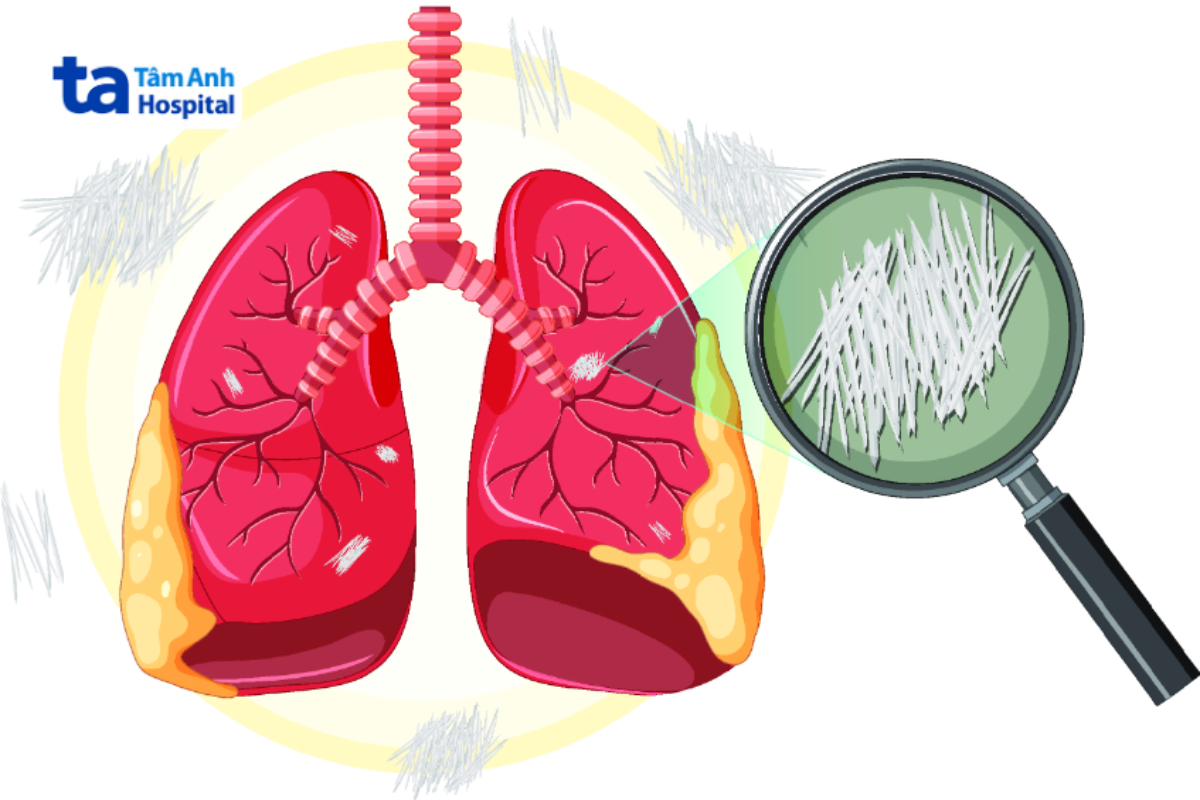 cơ chế gây bệnh bụi phổi