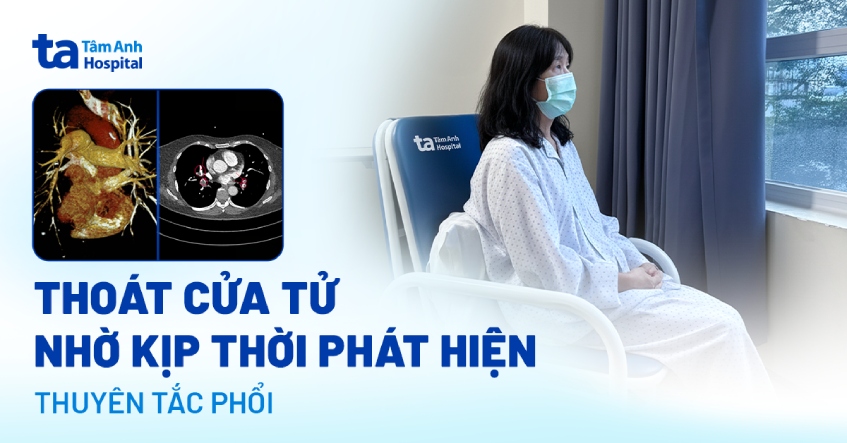 Cục máu đông âm thầm gây tắc động mạch phổi