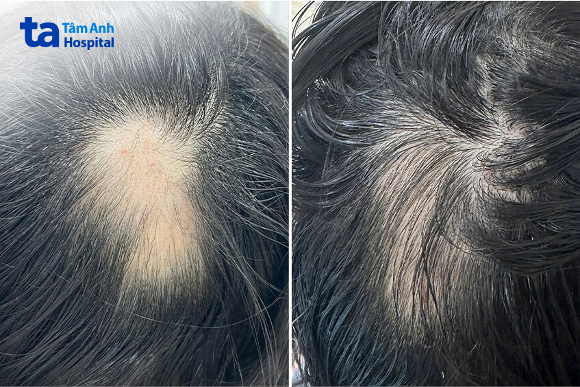 điều trị hói đầu trước và sau