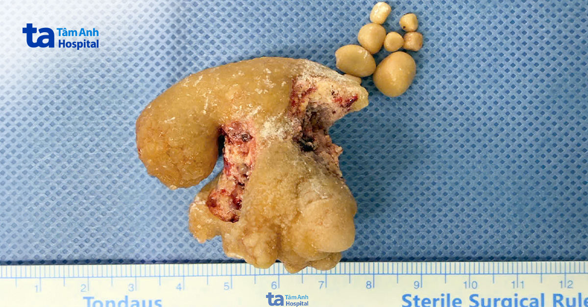 Dùng robot lấy sỏi san hô cho Việt kiều Mỹ