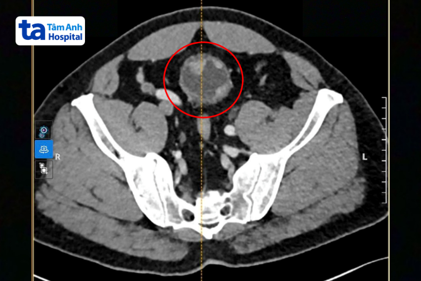 hình ảnh ct ghi nhận khối u