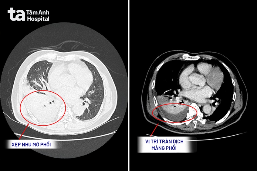 hình ảnh ct scan phổi của ông tỉnh ghi nhận tình trạng tràn dịch màng phổi, xẹp nhu mô phổi