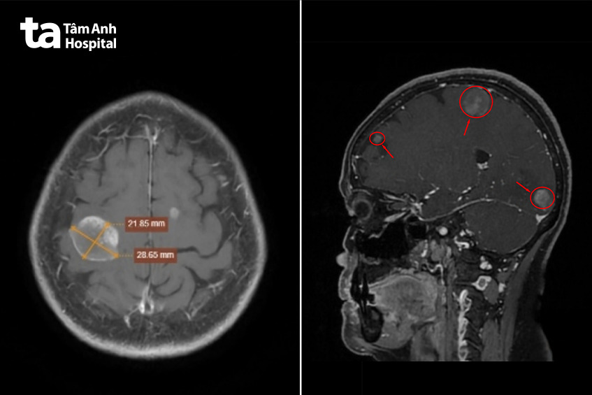 ảnh MRI não chụp bằng hệ thống 3 Tesla Signa Hero cho thấy các khối u di căn xuất hiện tại não của người bệnh