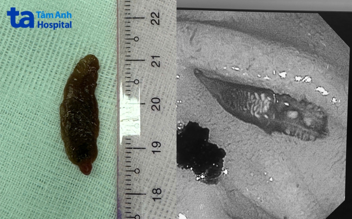hình ảnh sán lá gan qua nội soi