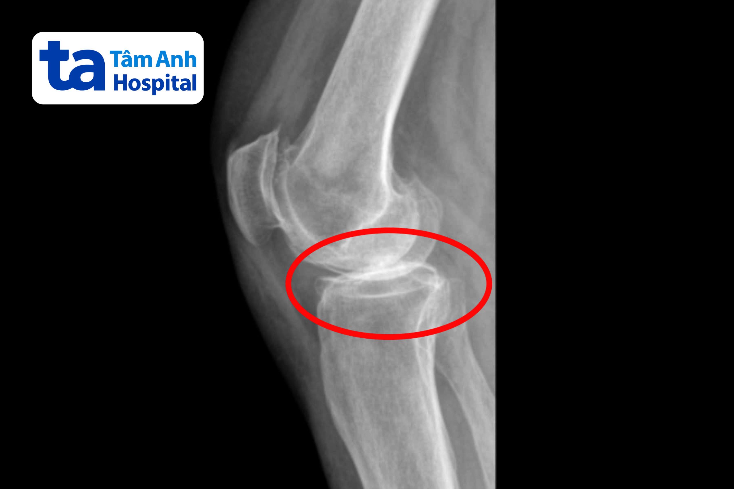 hình ảnh x quang xương người bệnh