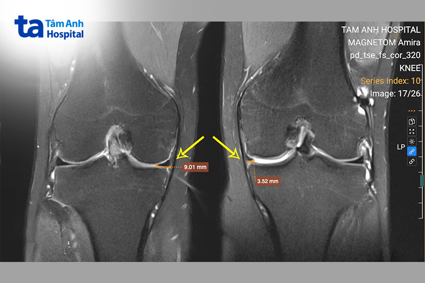 khớp gối trái của Quang khuyết thiếu sụn chêm trong so với gối phải