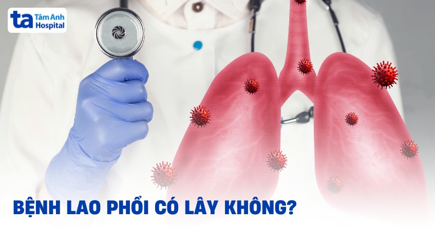 Bệnh lao phổi có lây không? Cơ chế lây nhiễm như thế nào?