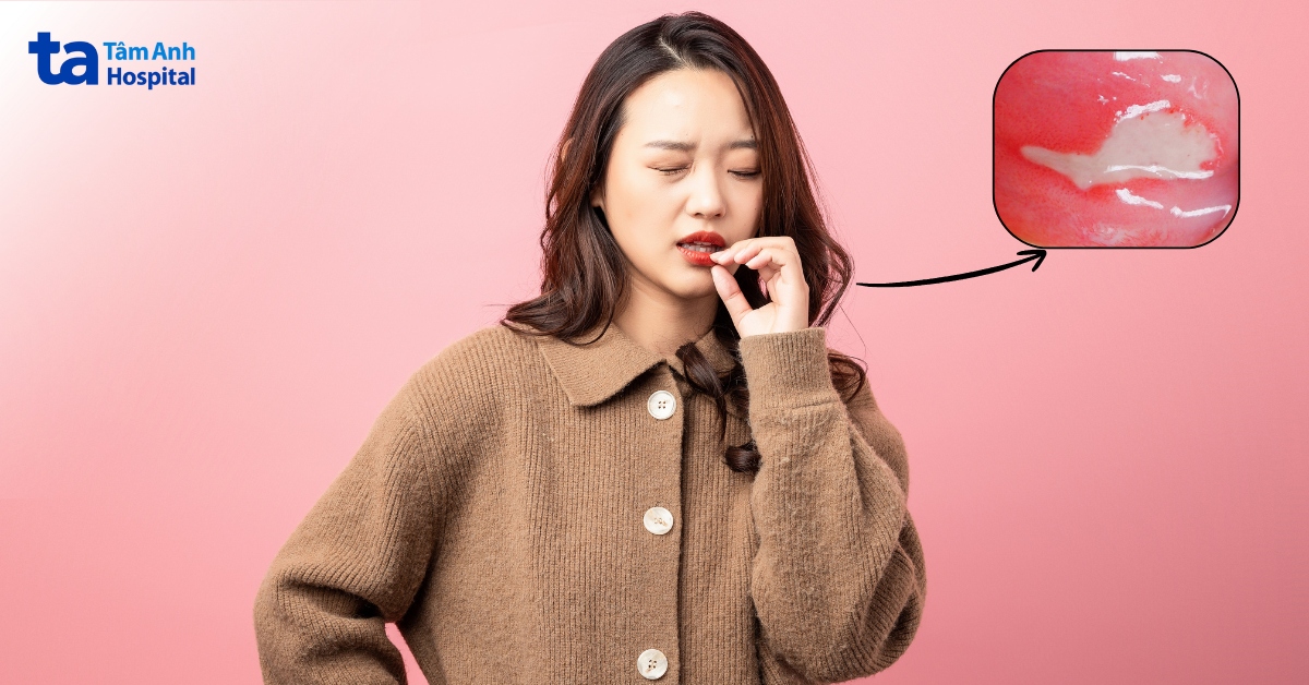 Loét miệng do đồng nhiễm vi khuẩn và nấm