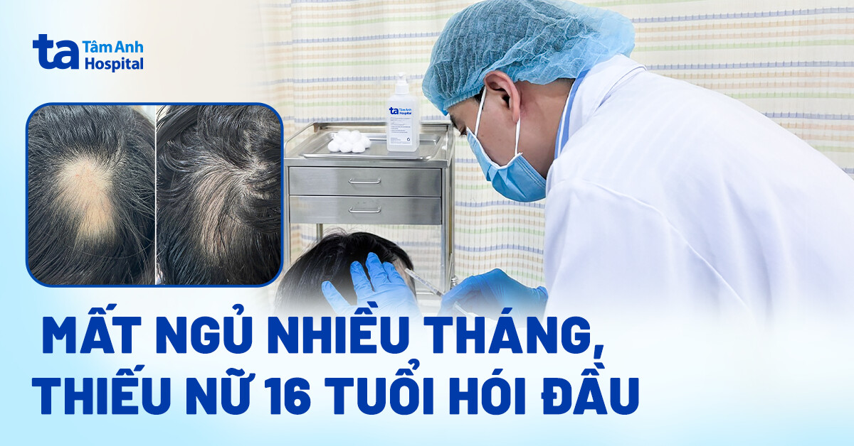 Mất ngủ nhiều tháng, thiếu nữ 16 tuổi hói đầu
