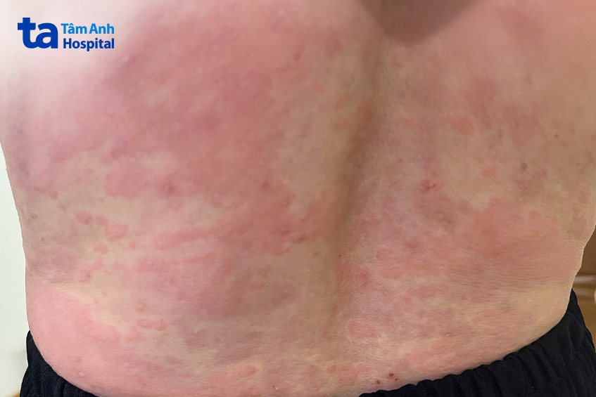 mỗi lần ra gió hay chạm nhẹ vào các đồ vật cũng khiến bà minh nổi mề đay khắp người