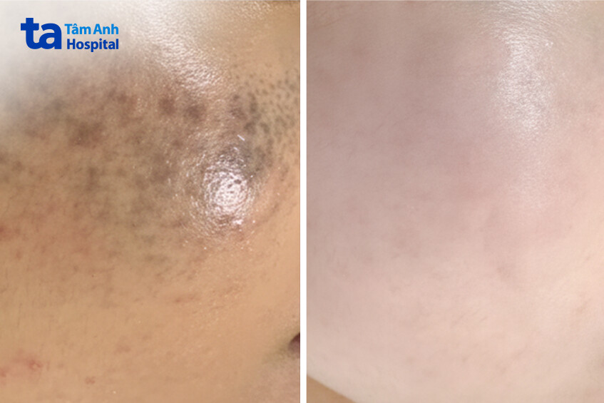 người bệnh trước và sau khi điều trj