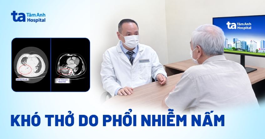 Phổi ngập dịch do nhiễm loại nấm mốc thường gặp