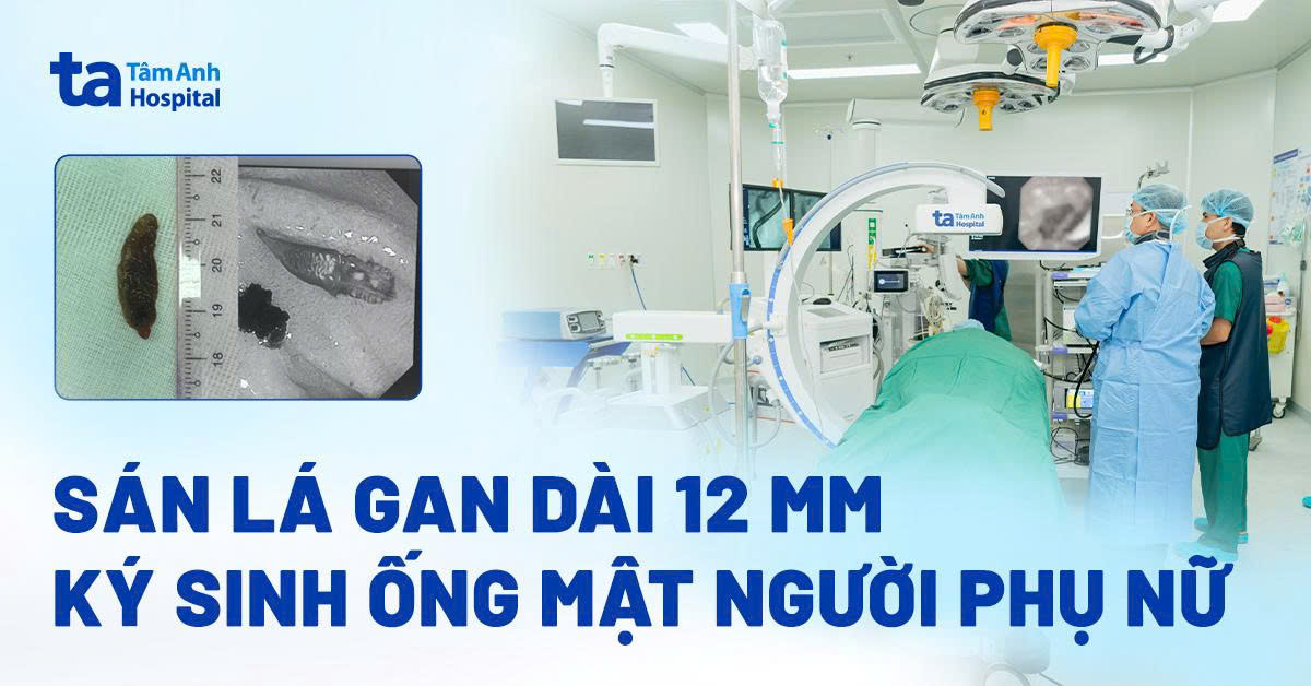 Sán lá gan dài 12 mm ký sinh ống mật người phụ nữ