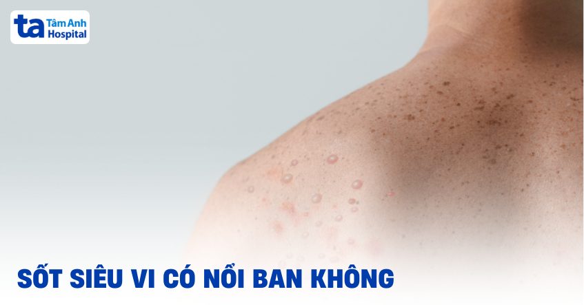 Sốt siêu vi có phát ban không? Đặc điểm và hướng xử trí