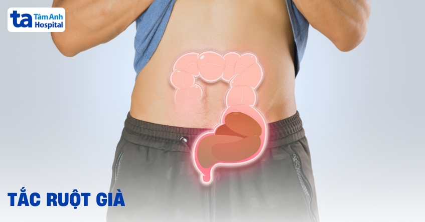 Tắc ruột già và những lý do gây vấn đề