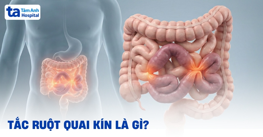 Tắc ruột quai kín là gì? Khác gì so với thông thường?